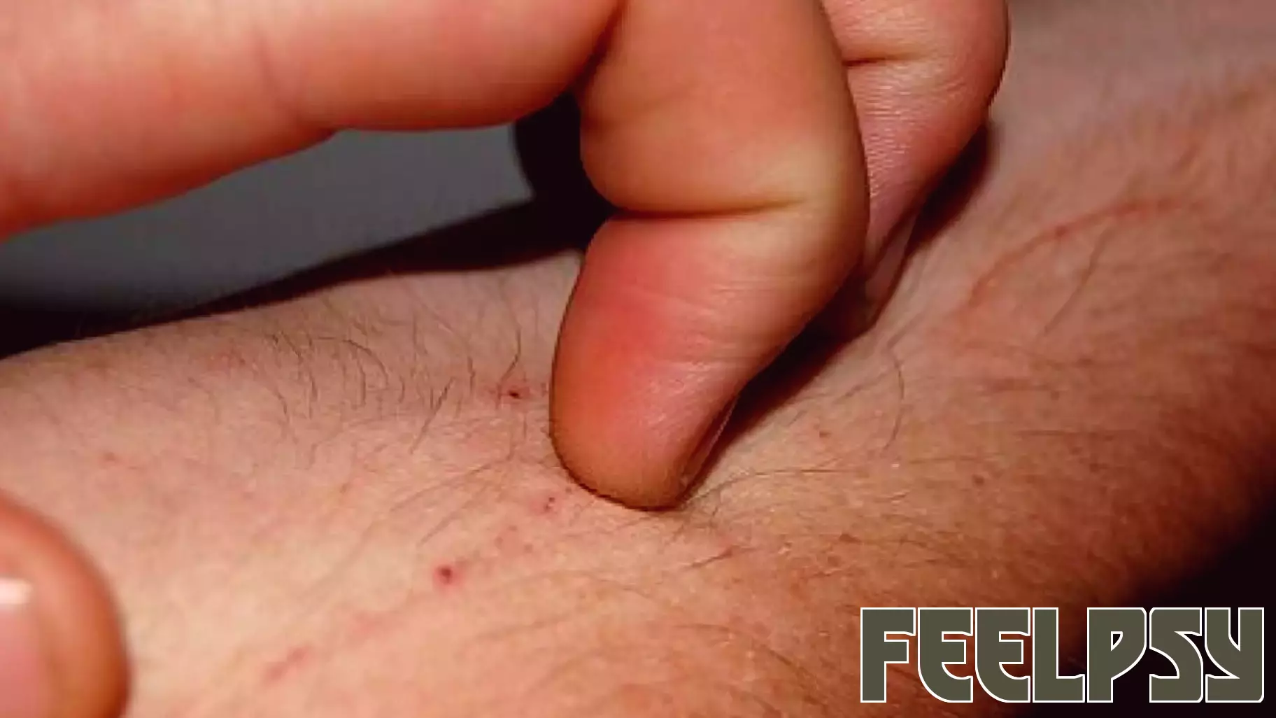 The Art of Describing Itches: A Path to Better Treatment